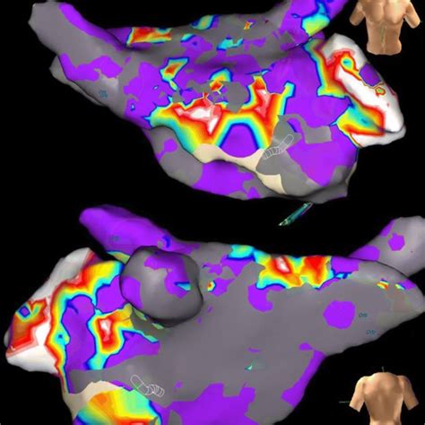 Electroanatomical Map Of The Left Atrium In AP And PA View Grey Areas