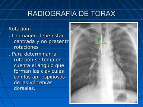 rayos x, torax normal