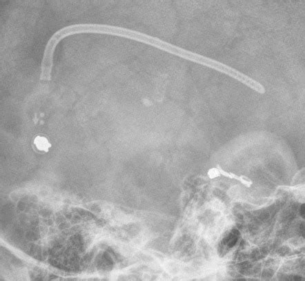 Programmable Medtronic Ventriculoperitoneal Shunt Image Radiopaedia Org