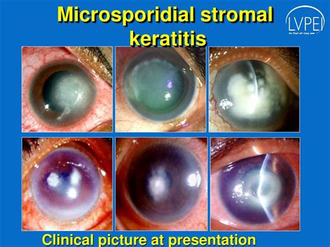 Ppt Microsporidial Stromal Keratitis Dilemma In Clinical Diagnosis Powerpoint Presentation