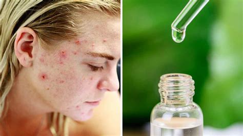 Does Niacinamide Help with Acne? The Science Behind It!