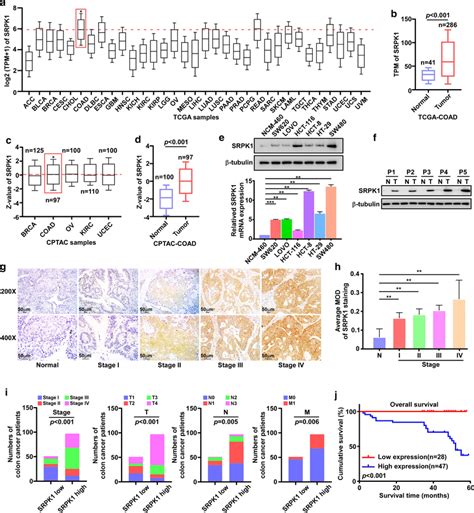 SRPK1 Is Overexpressed And Associated With Clinical Stage TNM