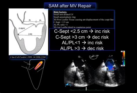 Quantitative Echocardiographic Assessment Of Mitral Regurgitation