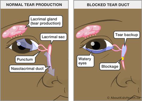 blocked-tear-duct - Theayurveda