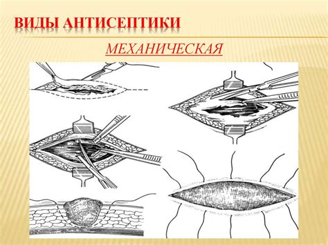 Антисептика. Определение. Значение работ Пастера, Листера, Пирогова ...