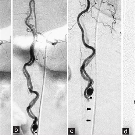 Spinal Angiography Obtained 3 Years After Endovascular Treatment