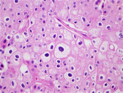 Chromophobe renal cell carcinoma - MyPathologyReport.ca