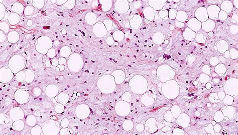 Liposarcoma Histology