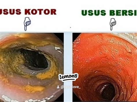 Tanda Usus Tidak Sihat Kotor Galeri Disiarkan Oleh Pputlove Lemon