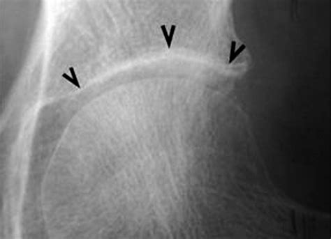 The Normal Hip Joint Space Variations In Width Shape And Architecture On 223 Pelvic