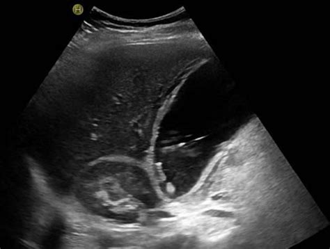 Abdomen and retroperitoneum | 1.2 Gallbladder and bile ducts : Case 1.2.6 Gallbladder ...