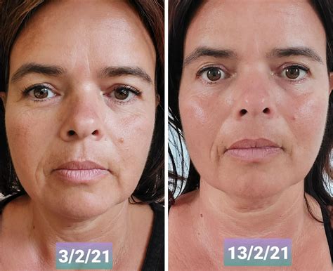 Yoga Facial Antes E Depois - Face Yoga Before And After How Does Face Yoga Help In Reducing A