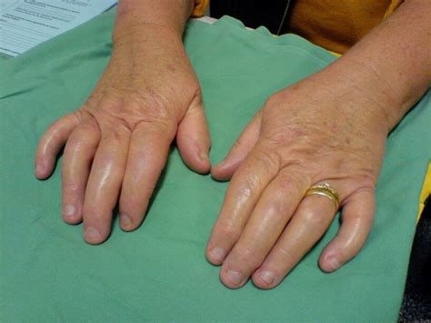 Фото псориаза здесь! А также причины, симптомы, лечение.