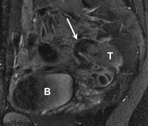 Mr Imaging Findings Of Hydrosalpinx A Comprehensive Review Radiographics