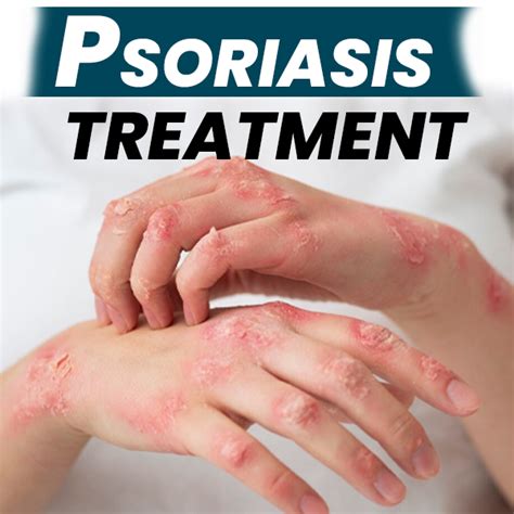 Natural And Permanent Solutions For Scalp And Skin Psoriasis By Bharat Homeopathy Jun 2024