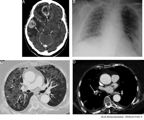 Pneumocystis Jirovecii Pneumonia Complicating The Progress Of A Patient With Glioblastoma