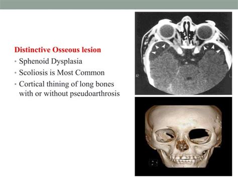 Neurocutaneous syndrome