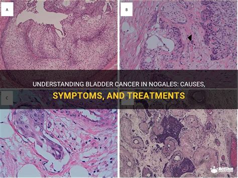 Understanding Bladder Cancer In Nogales Causes Symptoms And Treatments Medshun