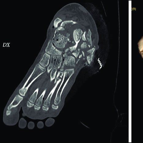 A Preoperative CT Scan Sagittal View B Preoperative CT Scan