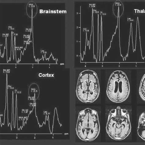 3 Regions Selected To Study Magnetic Resonance Spectroscopy