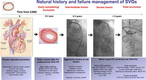 Saphenous Vein Graft Failure From Pathophysiology To Prevention And