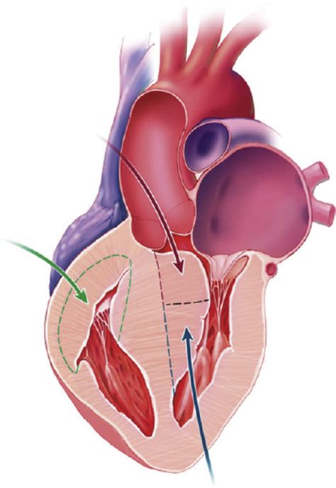 Surgical Ventricular Septal Myectomy For Patients With Noonan Syndrome