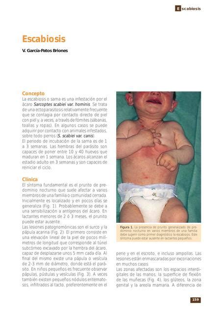 ESCABIOSIS EN PEDIATRIA G Aldo UDocz