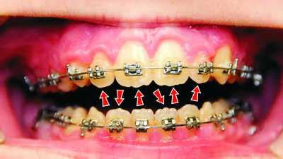 Removing Mamelons | Ask an Orthodontist.com