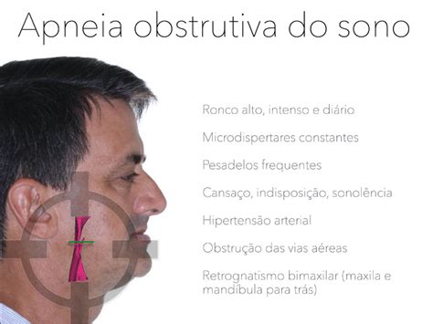 Ronco E Apneia Do Sono Dr Eduardo Parente