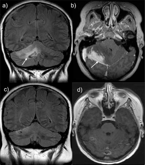 MRI Brain Imaging MRI Brain Showing High Signal In The Right