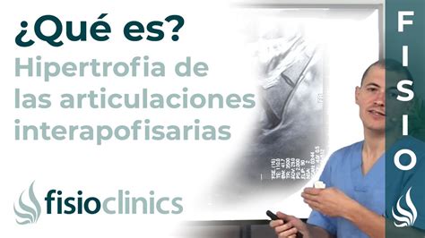 Hipertrofia de las articulaciones interapofisarias o facetarias Qué