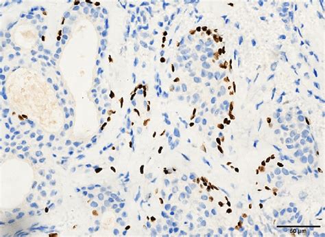 The Positive Staining Of P40 In Small Cells With Darkly Staining Nuclei