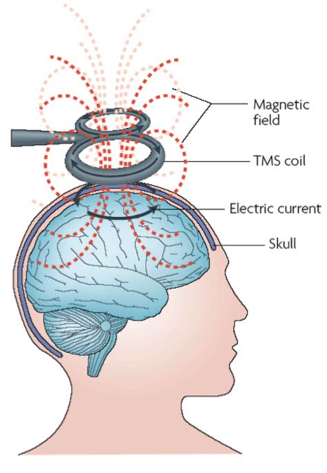 New Brain Stimulation Therapy Offers Fresh Hope For Depression