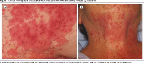 Figure 1 From Acute Generalized Exanthematous Pustulosis Induced By