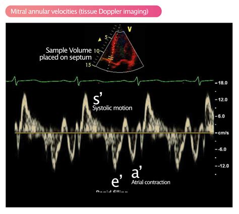 Assessment of diastolic function by echocardiography – Cardiovascular ...