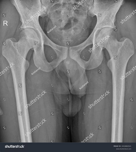 Bilateral Normal Hip Joint Anteroposterior Radiograph Stock Photo