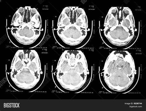 Ct Scan Brain Image & Photo (Free Trial) | Bigstock