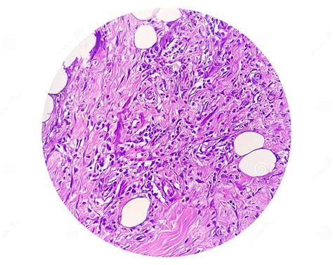 Photomicrograph of Granulomatous Tissue Histology Stock Image - Image ...