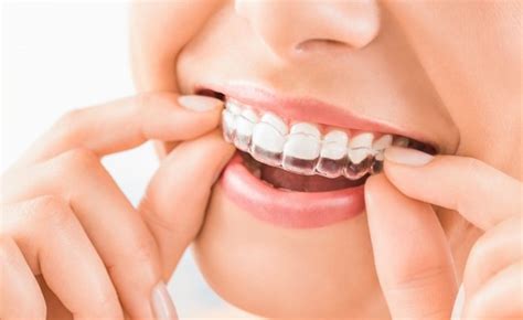 Tips For Wearing Invisalign For Hours Every Day Premier Dental Care