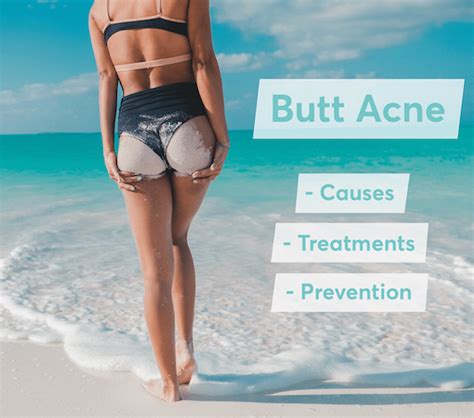 Butt Acne Common Causes And Treatments R Beautyskincareblogs