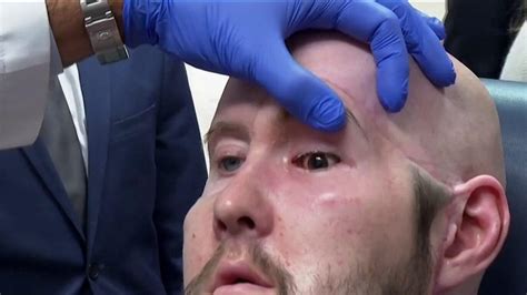 Primer Trasplante De Ojo Humano Completo En Nueva York Salud N