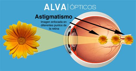 Anomalías de la visión parte III el astigmatismo ALVA ÓPTICOS