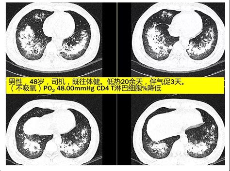 秒懂：肺部感染影像，看这篇就够了