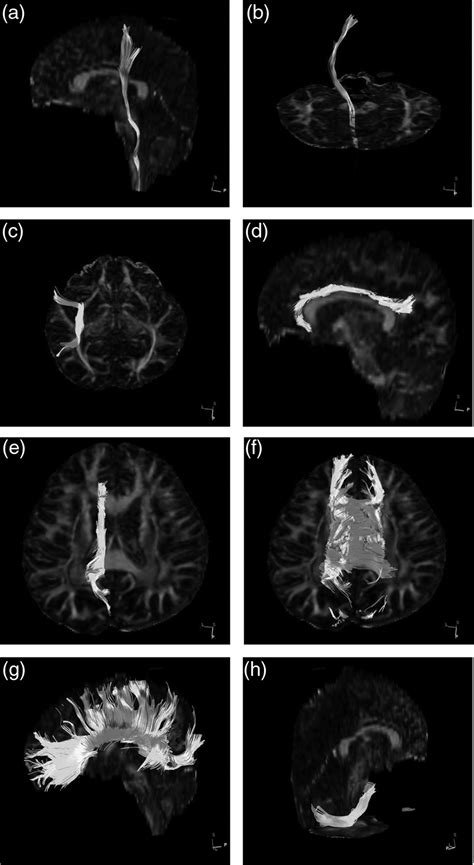 Microstructural White Matter Changes In Chronic Migraine Pat