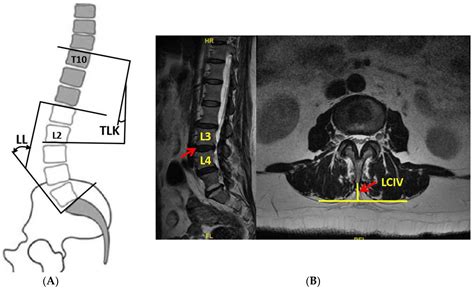 Jpm Free Full Text Correlation Between Degenerative Thoracolumbar