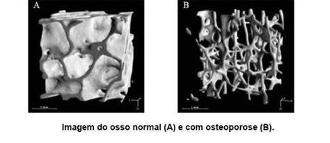 Osteoporose Dra Daniele Zaninelli