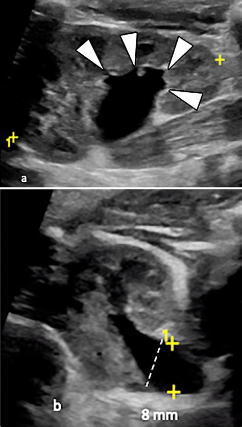 Urinary Tract Dilation Utd Classification P1 A B Sagittal A And