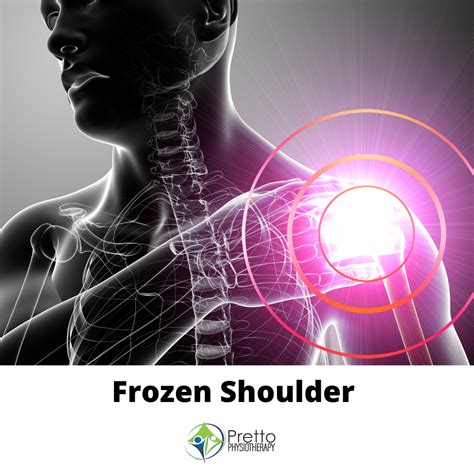 Frozen Shoulder Pretto Physiotherapy