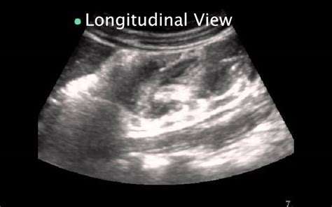 Pediatric Intussusception Youtube