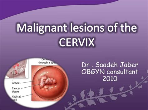 Ppt Malignant Lesions Of The Cervix Powerpoint Presentation Free